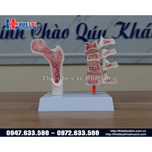 Mô hình bệnh lý loãng xương